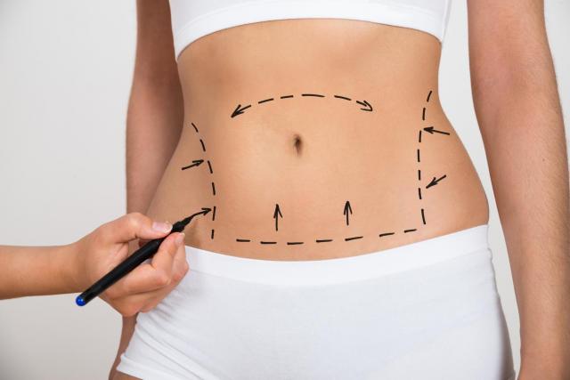  Modelowanie ciała - czy liposukcja jest naprawdę skuteczna?